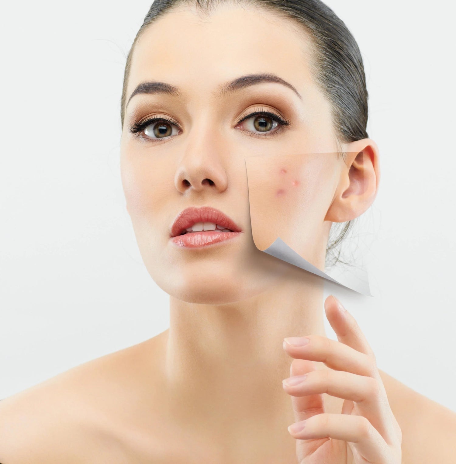 Acne Prone Dahl Faces